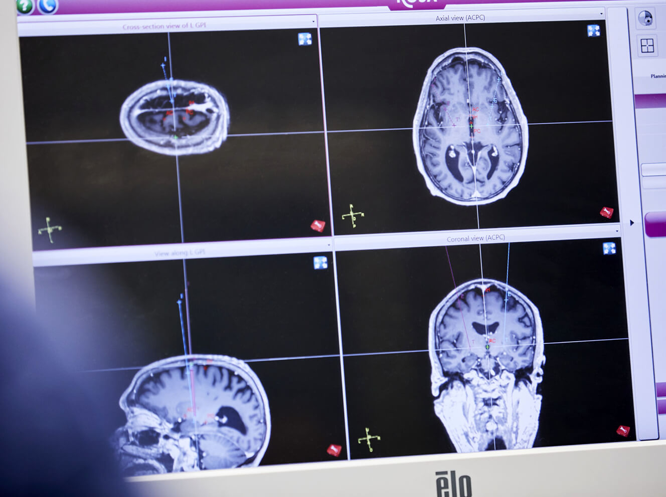 Mass General Neuroscience is leveraging imaging, data science and more to provide hope for individuals and families suffering from or at risk for Alzheimer’s, epilepsy and depression.